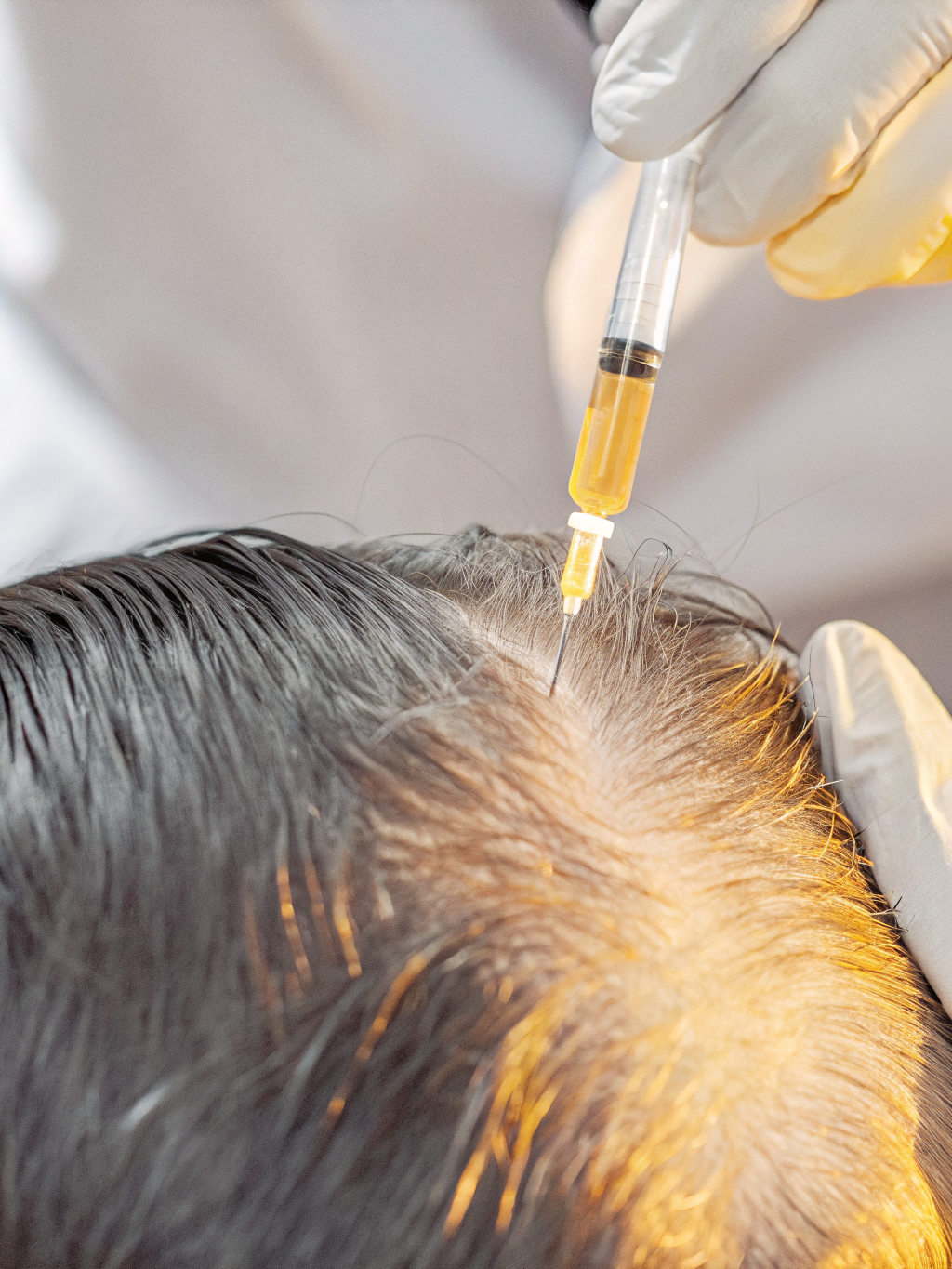 Mesoterapia Capilar